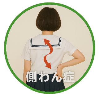 側わん症